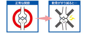 変形性関節症イメージイラスト